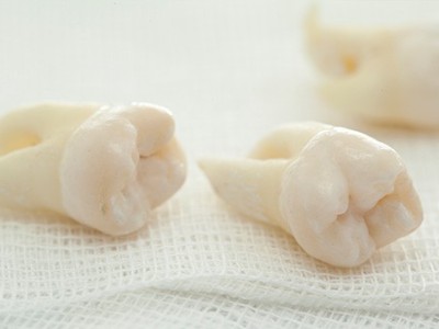 智齒疼了，這牙非拔不可嗎？