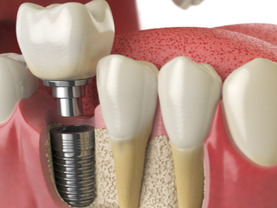 選擇種植牙后要做哪些日常維護(hù)？