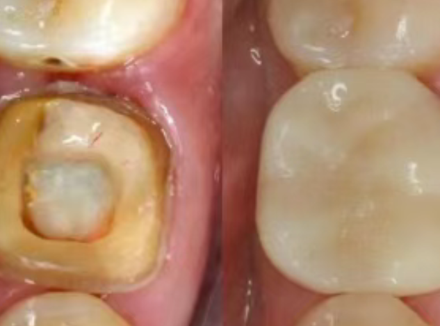 根管治療（抽神經(jīng)）后，為什么一定要做牙冠？