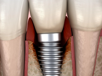 種植牙的術(shù)前準(zhǔn)備有哪些？
