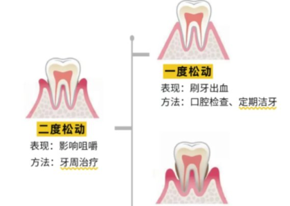 老年人牙齒松動(dòng)了要怎么辦？
