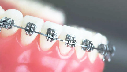 傳統(tǒng)托槽矯正