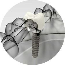 術(shù)前研究、模擬提升種植成功率