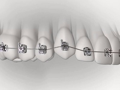 承德市哪家口腔醫(yī)院口腔正畸做得好？惟德口腔醫(yī)院來(lái)告訴您