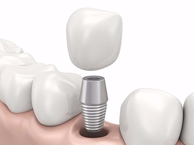 在承德哪家口腔醫(yī)院口腔種植齒好一點(diǎn)，惟德口腔醫(yī)院值得您的選擇