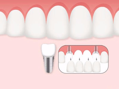 惟德口腔口腔種植怎么樣？惟德口腔就來為您一一解答