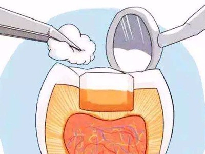 惟德口腔淺析在承德孩子牙齒蛀牙補(bǔ)牙需要多少錢(qián)